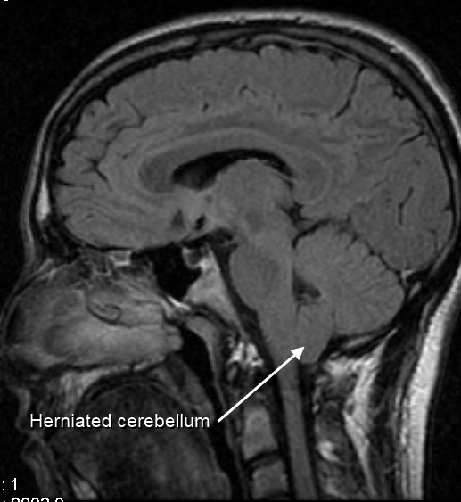 Sagittal MRI of brain showing Chiari type I malformation with cerebellar tonsillar herniation