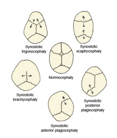 Diagram showing the different types of craniosynostosis categorised by affected cranial suture