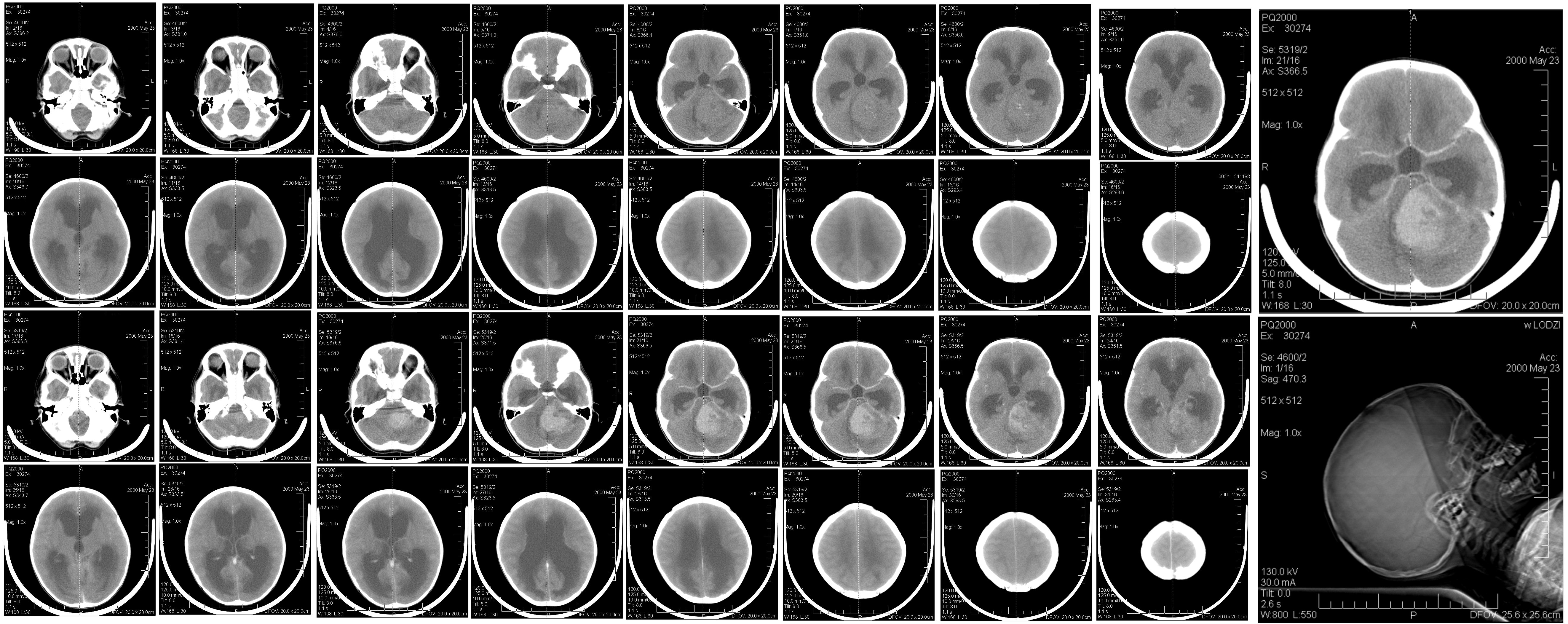 Non-contrast CT in a 6-year-old child showing a posterior-fossa mass with obstructive hydrocephalus