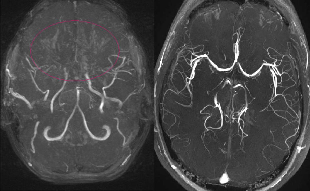 MR angiography showing moyamoya disease in an 11-year-old child compared with a healthy patient