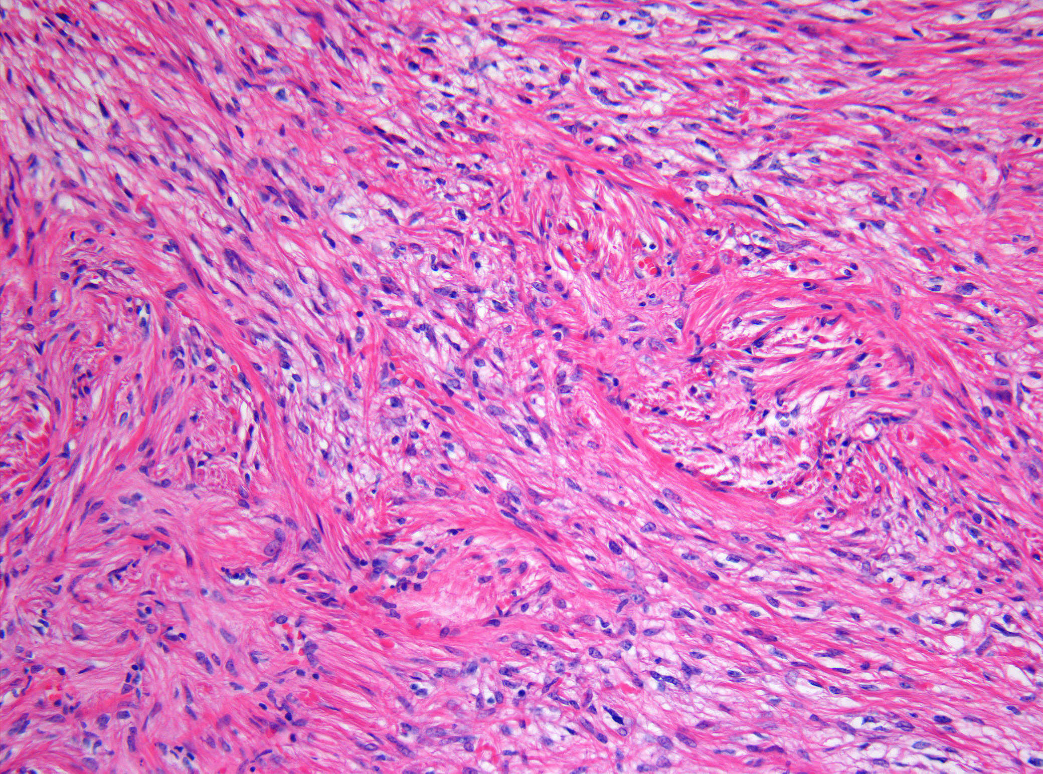 Histopathology of pilocytic astrocytoma, H&E stain at 200x magnification