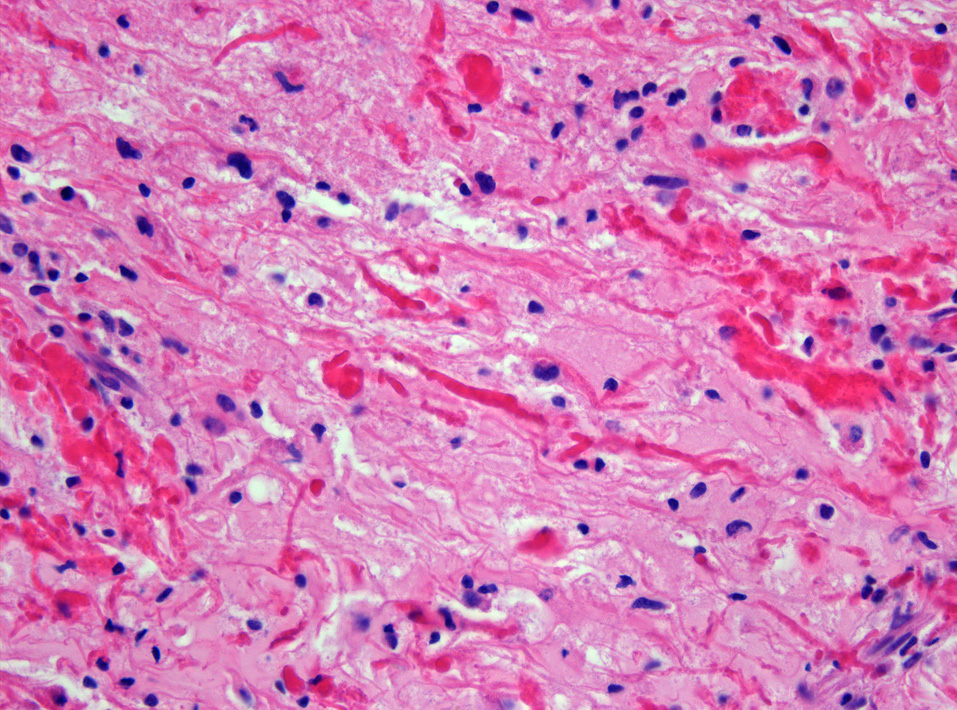 Rosenthal fibers in pilocytic astrocytoma, H&E stain at 400x magnification