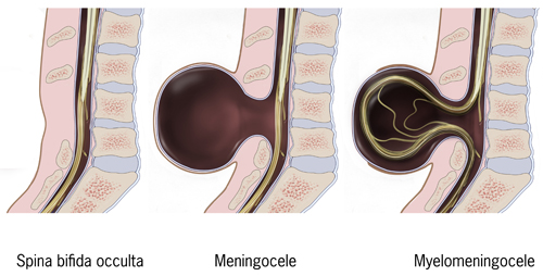 Diagram showing three types of spina bifida; spina bifida occulta, meningocele, and myelomeningocele