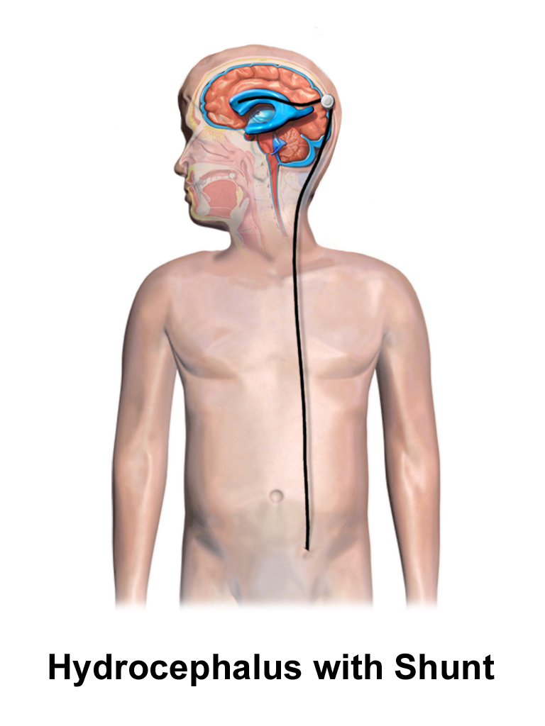 Medical illustration of a ventriculo-peritoneal shunt in a child